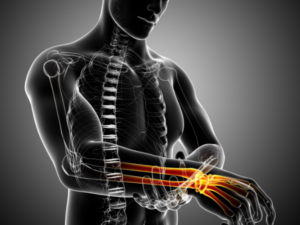 Chiropractor Carpal Tunnel Syndrome