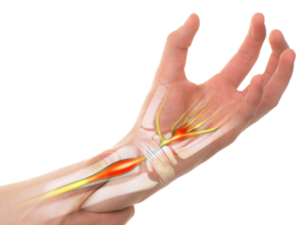 Chiropractor Carpal Tunnel Syndrome