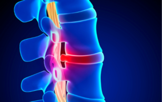 heal herniated disc without surgery