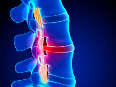 How to Heal a Herniated Disc Without Surgery - ProCare